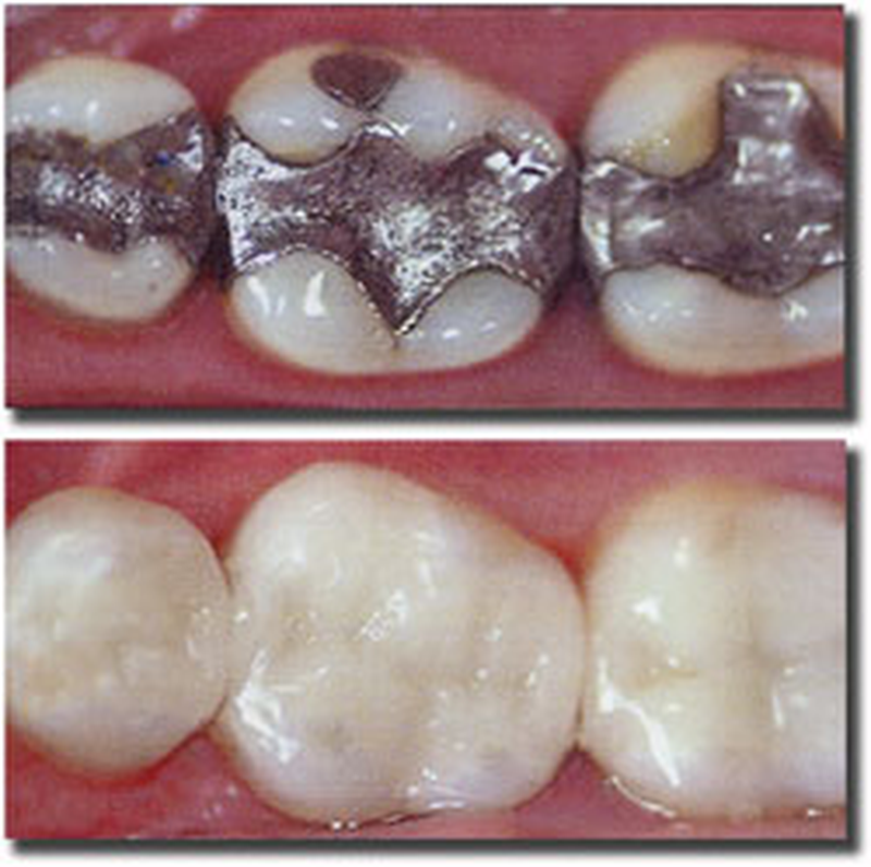 Amalgam to white composite filling before and after